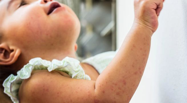 Nueva York: alerta por epidemia de sarampión en Brooklyn