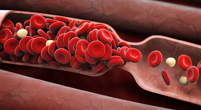 Estudio revela por qué se forman coágulos de sangre en pacientes con Covid-19
