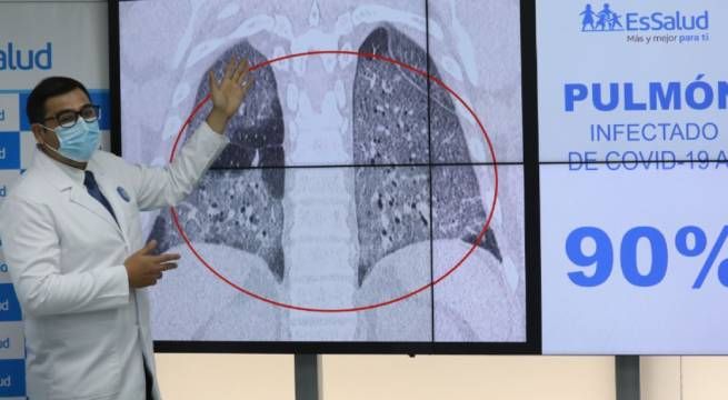 EsSalud: Covid-19 podría dañar la totalidad del pulmón en solo 4 días