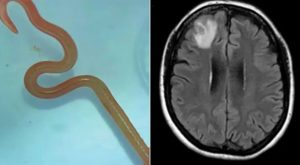 Médicos extraen lombriz de ocho centímetros en cerebro de mujer