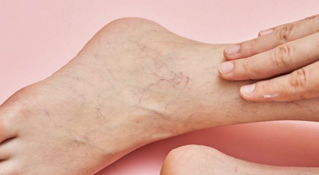 ¿Dolores por varices? Esto debes hacer para aliviarlos