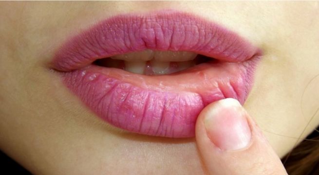 Cuáles son los síntomas del cáncer de boca y cuándo se debe acudir a un médico