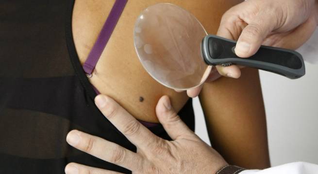 Cáncer de piel: mira cuándo se lanzaría vacuna sin precedentes contra el melanoma