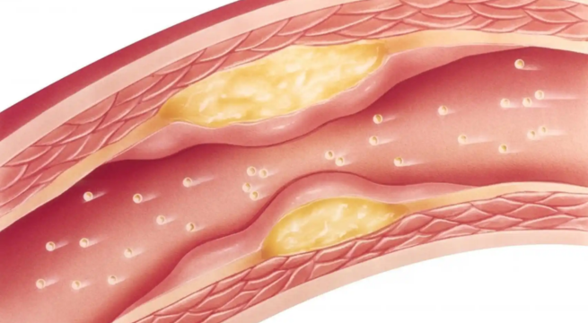 El colesterol es un enemigo silencioso: secretos genéticos y hábitos que debes tener en cuenta