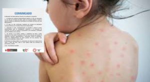 Minsa detecta caso de sarampión en menor de 10 meses de edad en Surco