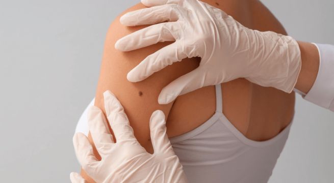 Cáncer de piel: sigue estos consejos para prevenir esta enfermedad